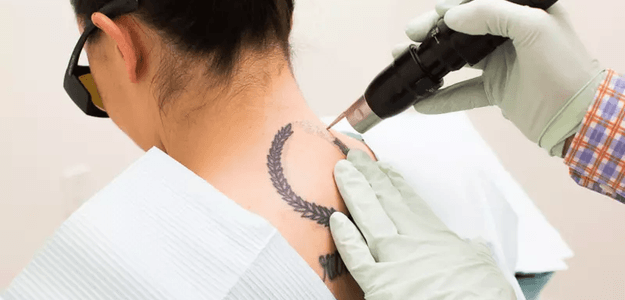 Laser Tattoo Removal in Dubai: The Latest in Skin Technology