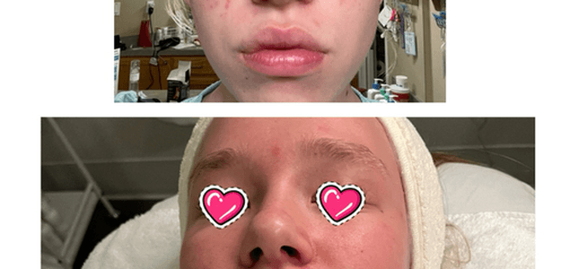 Acne facials near me