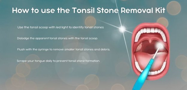 How to Use the Oravix Tonsil Stone Removal Kit: Step-by-Step Guide