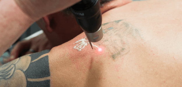 How Does Skin Type Affect Laser Tattoo Removal Results?