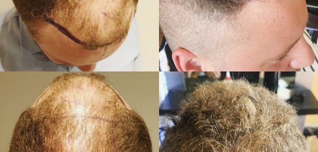 Why Is Hair Transplant in Southampton a Smart Choice for Your Hair Restoration Journey?