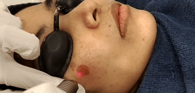 Is Pico Laser effective for large pores?