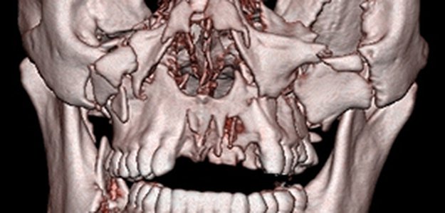 Living with Facial Trauma? How Maxillofacial Surgery Can Help You Recover