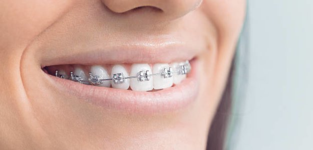 Discovering Braces Near Marshall: Your Path to a Beautiful Smile