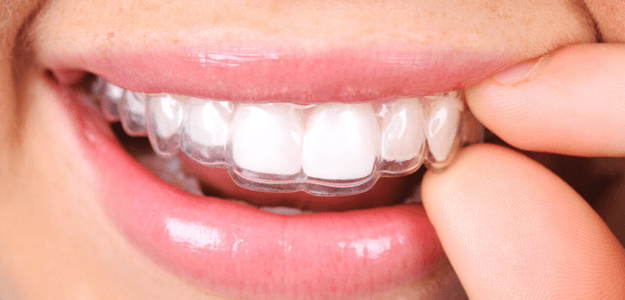 «SmileHome» - Элайнеры в 2 раза дешевле без визита к стоматологу. (Отзыв - 5.)