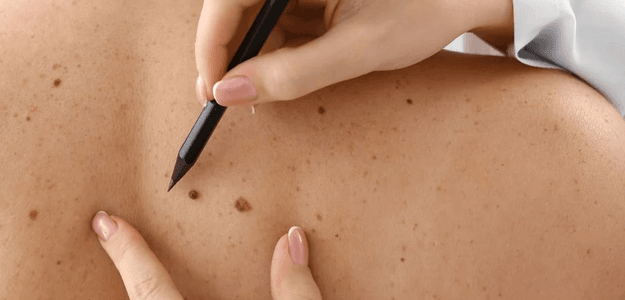 Skin tag removal: Is it worth it?