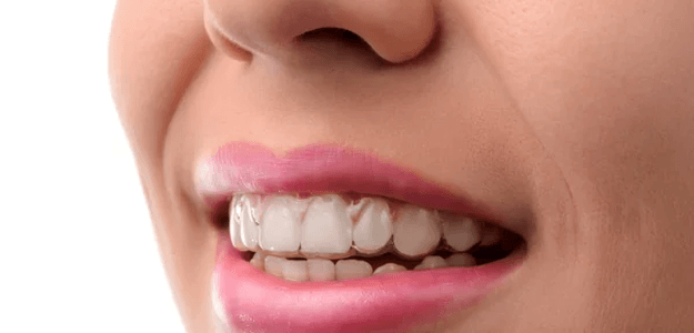 Are Invisalign Braces Affordable in Dubai?