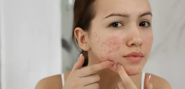 Reclaiming Your Glow: Acne Scar Treatment in Islamabad