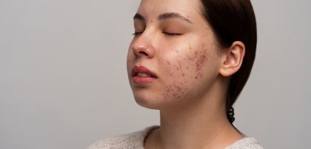 Affordable Acne Scar Treatments In Singapore: Your Options Explored