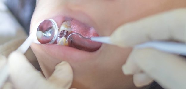 Pros and Cons of Teeth Fillings