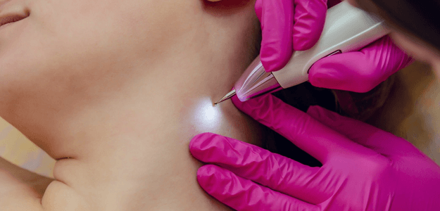 Skin Tag Removal: Fast, Safe, and Effective