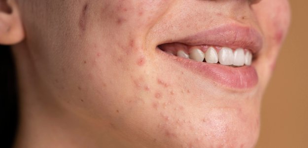 Acne treatments in Auckland
