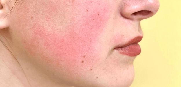 Rosacea Treatment: Natural Remedies and Medical Options