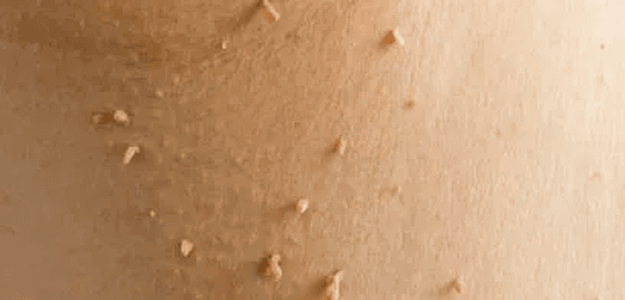 Skin Tag Removal Dubai: Safe and Swift Solutions