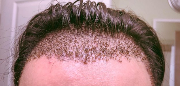 Hair Transplant in Dubai: A New Chapter for Your Hair