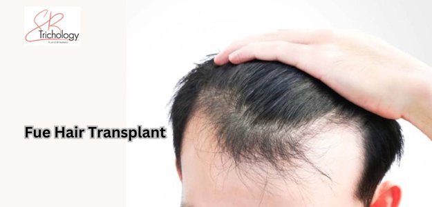 Why Should One Consider Going For A FUE Hair Transplant?