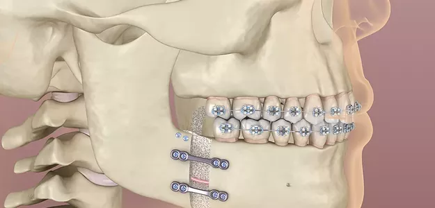 Corrective Jaw (Orthognathic) Surgery: Types of Procedures and Treatments