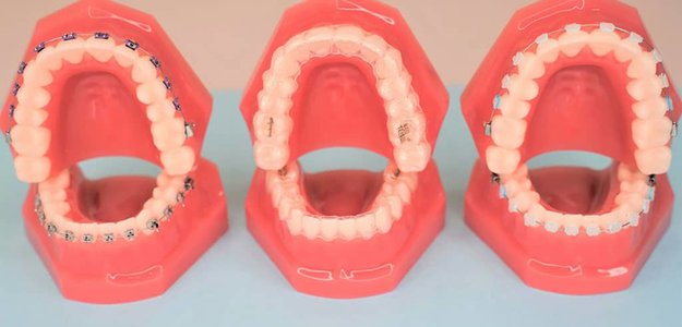 Tips for Deciding on the Perfect Braces Color for You