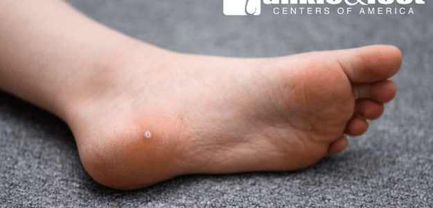 What Is a Plantar Wart?