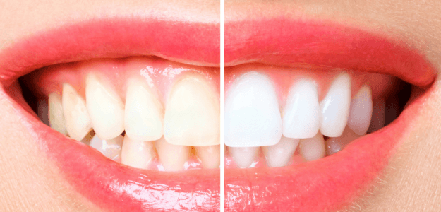 The Truth About Cosmetic Dentistry Costs in West Hollywood