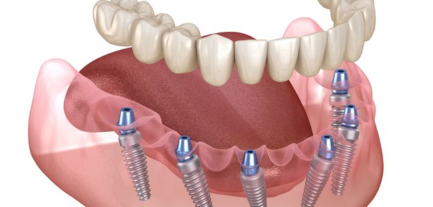 Full Arch Dental Implants for Missing Teeth