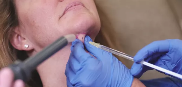 Get Rid of Double Chin | Kybella Treatments Lewis Center, OH