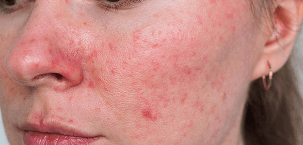 Rosacea Treatment: Topical Medications Explained