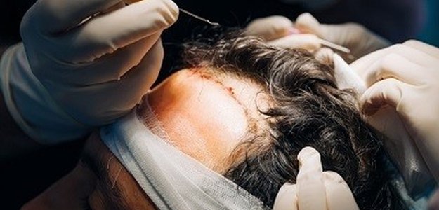 How long until I see the final results of my hair transplant?