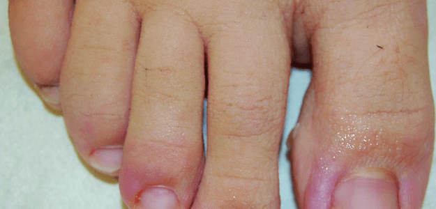 5 Tips for Ingrown Toenails Remedies You Can Do At Home