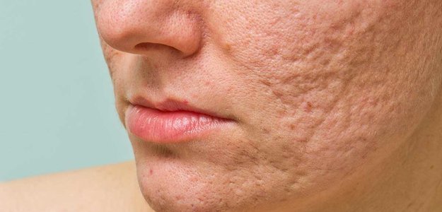 Dubai's Dermatology Oasis: Solutions for Acne Scars