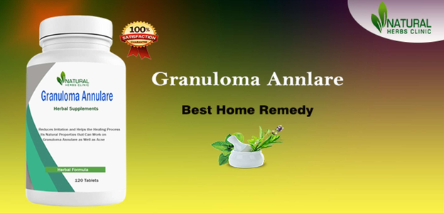 Herbal Medicine What You Should Know About Granuloma Annulare