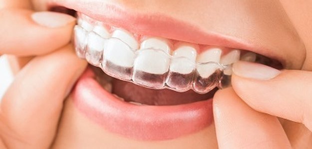 How Much Do Invisalign Braces Treatment Cost in Dubai?