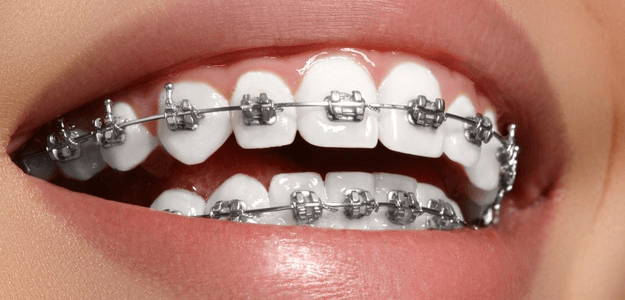 What Are the Different Types of Braces?