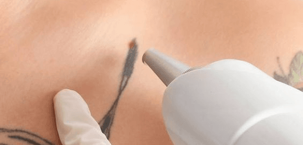 Explore Advanced Laser Tattoo Removal Methods