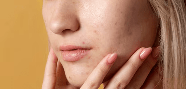 Are You Ready for Melasma Treatment? Find Out Now!