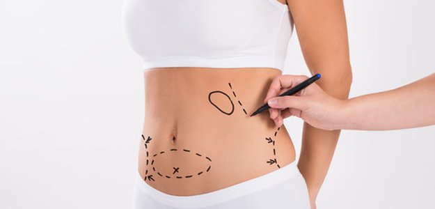 Is Liposuction Right for You? A Personalized Assessment