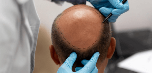 Is 25 Too Young for a Hair Transplant?