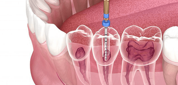 Root Canal Treatment for Sensitive Teeth: Options in Dubai