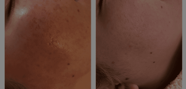 Liquid Microneedling