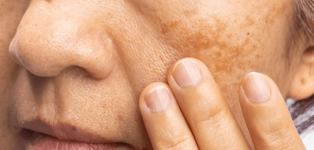 What is the fastest treatment for melasma?