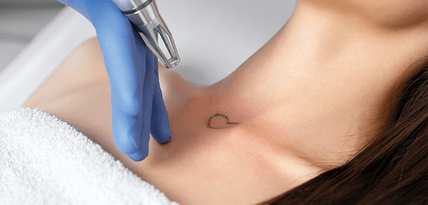 Get Rid of Tattoos Easily with Laser Tattoo Removal