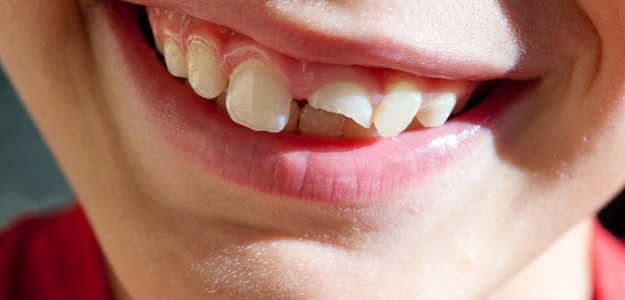 How to Correct Overlapping Teeth: A Comprehensive Guide