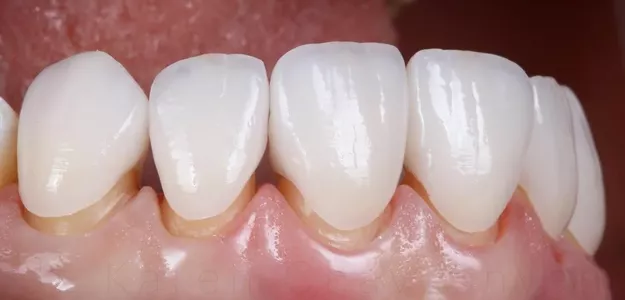 Achieving a Bright Smile: Everything You Need to Know About Dental Veneers