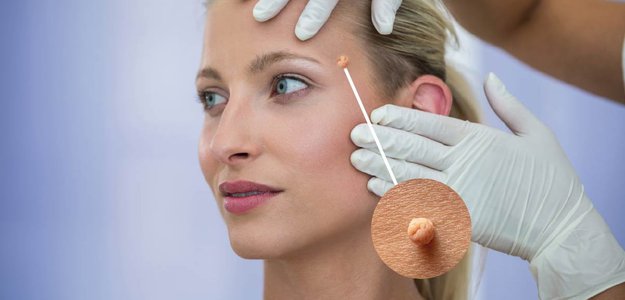 Skin Tag Removal: Doctor-Approved Methods