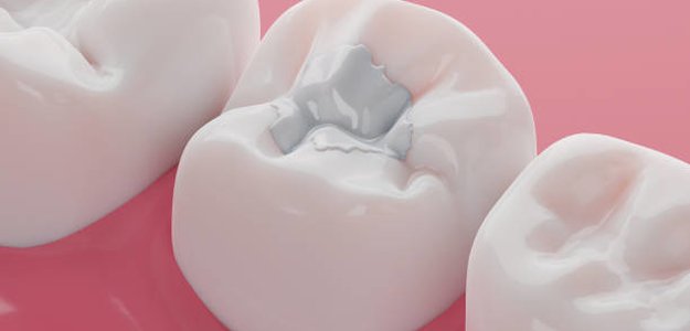 Treating Cavities Modern Approaches to Restoring Your Teeth