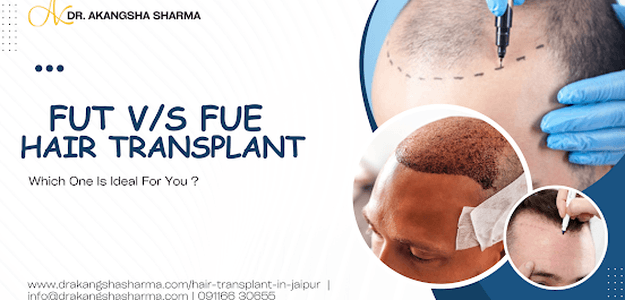 FUT v/s FUE Hair Transplant: Which One Is Ideal For You