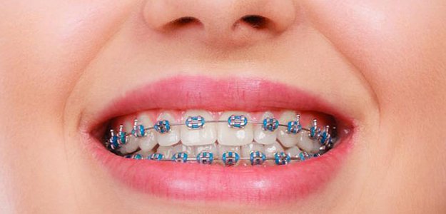 Innovative Techniques in Metal Braces for Faster Results