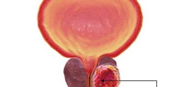 Prostate Cancer: Symptoms & Treatment