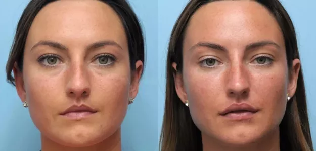 Discover the Secret to Youthful Skin with Thread Lift in Dubai