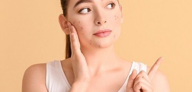 Effective Acne Solutions in Islamabad: What Works Best